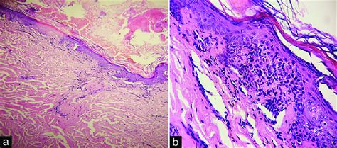 A Skin Biopsy Shows Hyperkeratosis Mild Atrophy Perivascular And