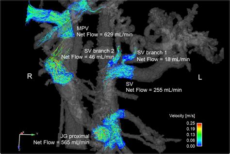 Quantitative Assessment Of Portal Jump Graft Inflow Following Liver