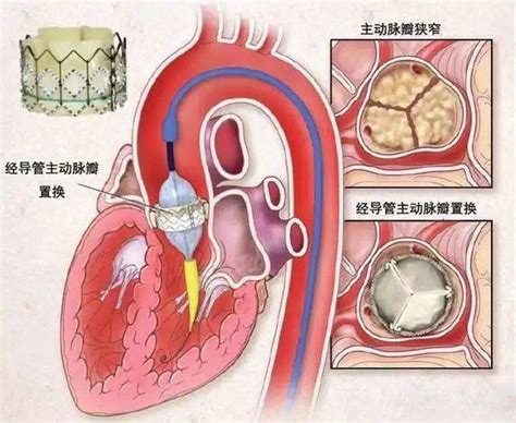 微创不开胸，高龄老人更换心脏主动脉瓣治疗