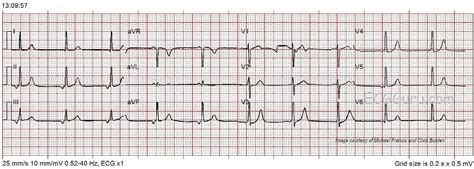 Junctional or Low Atrial Rhythm | ECG Guru - Instructor Resources