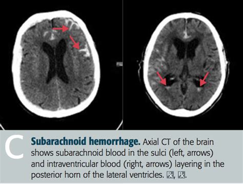 Subarachnoid And Subdural Haemorrhage Flashcards Quizlet