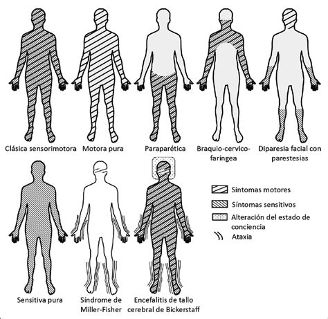 Entenda A Sindrome De Guillain Barre Sgb Clinica Motricita Otosection