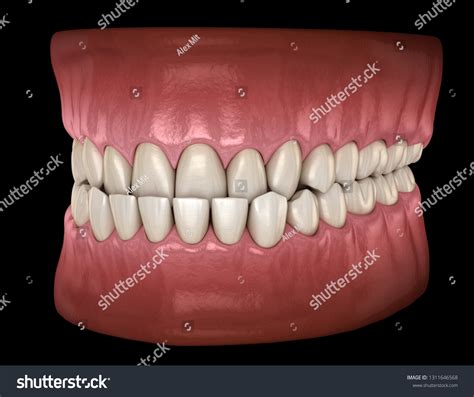 Underbite Dental Occlusion Malocclusion Teeth Medically Stock