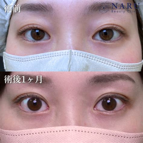 20代女性【二重埋没法】no78 二重整形専門のnaru Beauty Clinicナルクリ