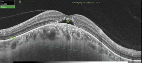 Swept Source Optical Coherence Tomography Ss Oct Of Re With Dsm