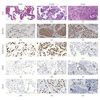 Immunostaining Score In Normal Lung Tissue Luad And Lusc Data