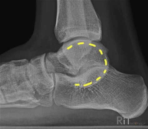 Tarsal Coalition - Pediatrics - Orthobullets