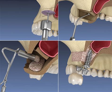 Sinus Lift Procedure | Dental Delhi