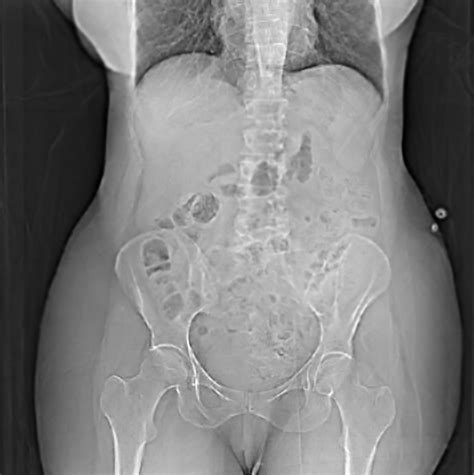 Hysterectomy - Seema Keeling
