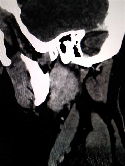 Left Parotid Warthins Tumor Tumor Radiology