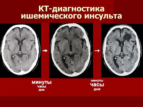 Патологоанатомический диагноз при инфаркты мозга - фото презентация