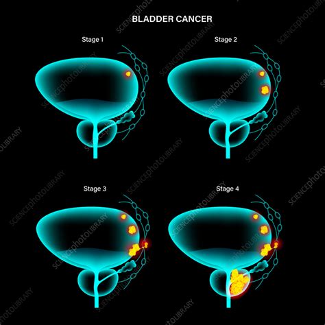 Bladder Cancer Stages Illustration Stock Image F035 7142 Science