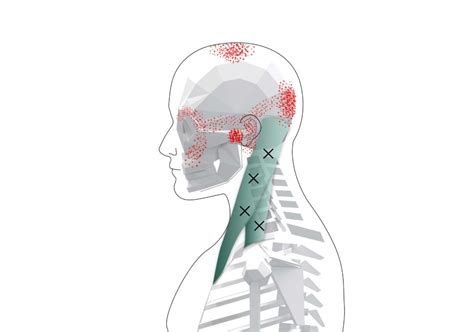 Sternocleidomastoid Trigger Points (Overview and Self Treatment)