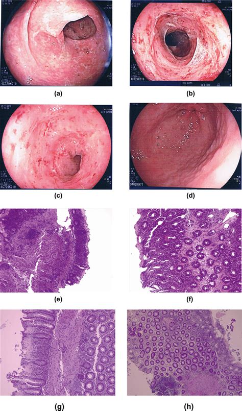 Endoscopic Appearance Of The Colon In Ascending Panel A Transverse Download Scientific