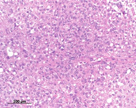 A Histology Of The Neoplastic Mass Right Testicle Consisting Of