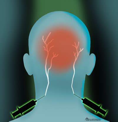 Occipital Neuralgia - Arch Advanced Pain Management