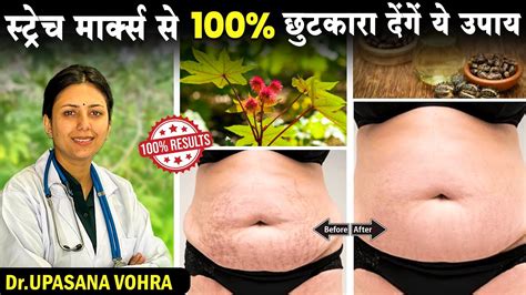 Stretch Marks को घर पर 100 कैसे ठीक करें How To Get Rid Off Stretch