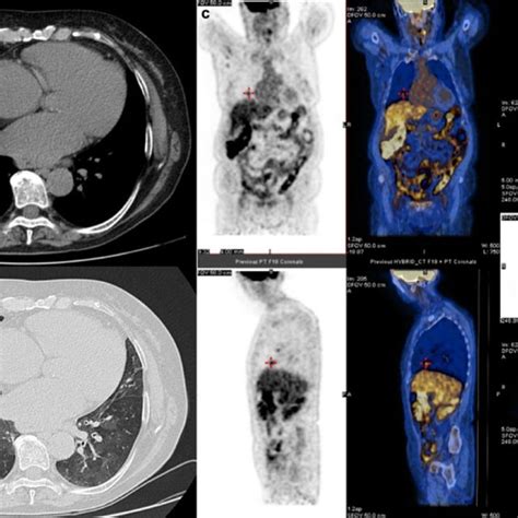 Axial A Mdct Pre Contrast Image Shows A Well Defined Nodule White