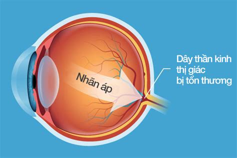 B Nh Glaucoma C M N C Nguy N Nh N V C Ch I U Tr B Nh Vi N M T