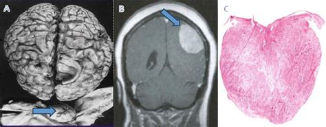 Diagnosis And Grading Of Meningiomas IntechOpen