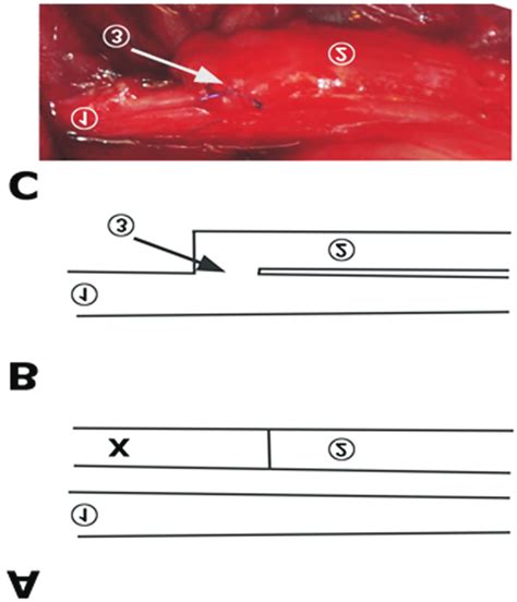 Intraoperative Picture And Schematic Illustration Of Surgical