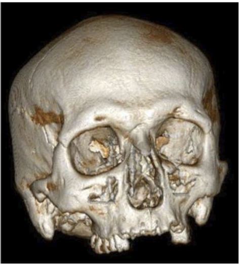 D Volume Rendering Image Of The Punic Skull There Are Not Significant