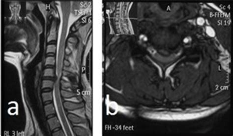 Cervical Disc MRI