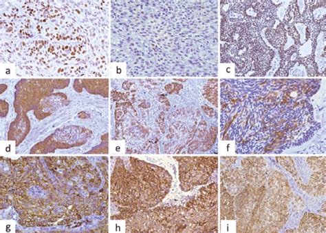 Main Immunohistochemical Features In Ameloblastic Carcinoma A Download Scientific Diagram