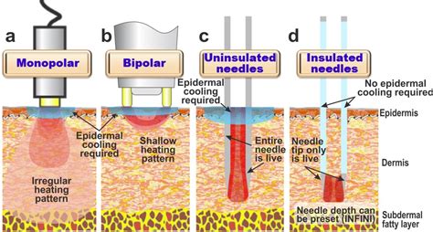 Infini Microneedling Radiofrequency Rf Northern Virginia Washington Dc