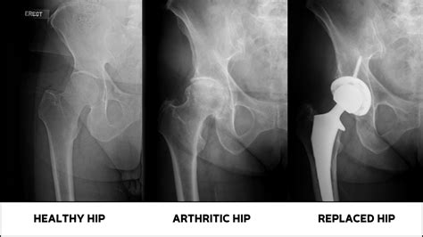 Treatment Options For Osteoarthritis Of The Hip Rothman Orthopaedics