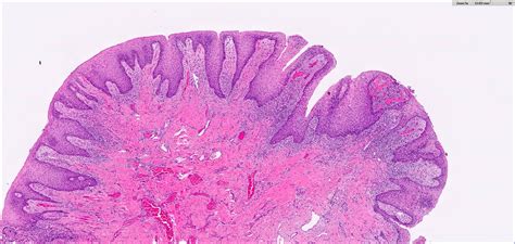 Pathology Outlines Inflammatory Fibrous Hyperplasia