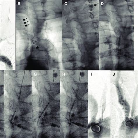 Surgical procedure of a carotid endarterectomy. Figure 2 summarizes a ...