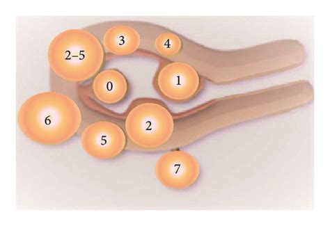 Figo Classification Of Myomas Figo Classification System Of Myomas