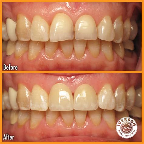 Before And After Smile Makeover Iverson Dental Labs