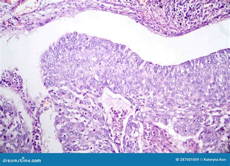 Lung Adenocarcinoma Light Micrograph Stock Image Image Of Tissue