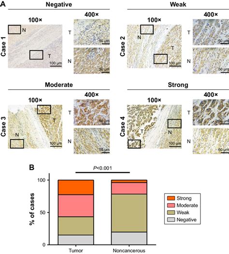 Immunostaining Of Zwint Protein In Human Hcc And Adjacent Normal