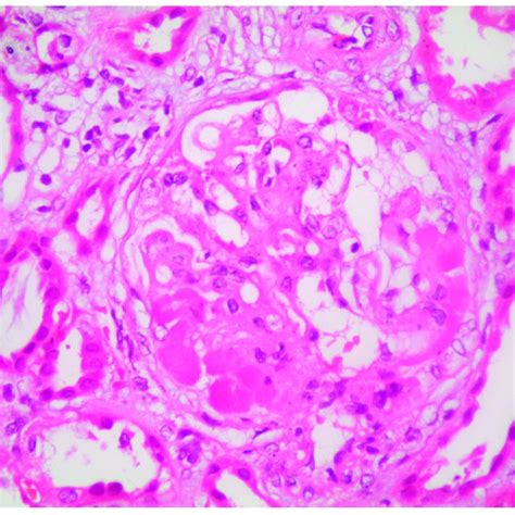 Cellular Glomerular Crescent In A Patient With Biopsy Proven Membranous