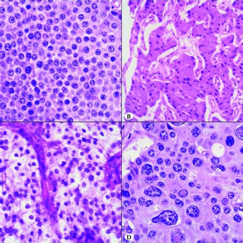 A Well Differentiated Neuroendocrine Tumor Wd Net Composed Of Download Scientific Diagram