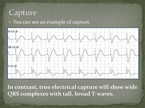 Transcutaneous pacing | PPT