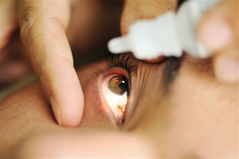 Uveitis Gejala Penyebab Dan Pengobatan Alodokter