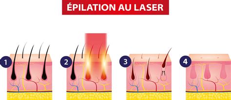 Pilation Laser D Roulement Avantages Et Inconv Nients