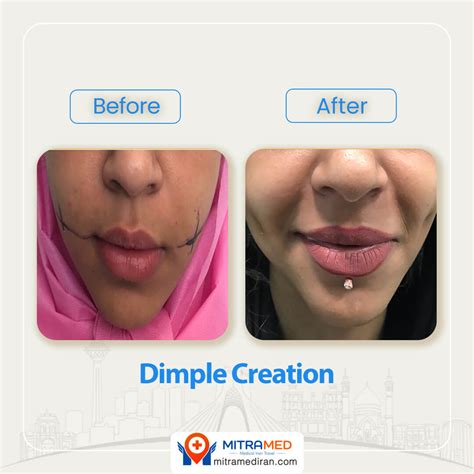 Dimple Surgery in Iran | Dimpleplasty | Dimple Creation | MITRAMED