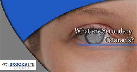 What is a Secondary Cataract? | Brooks Eye Associates