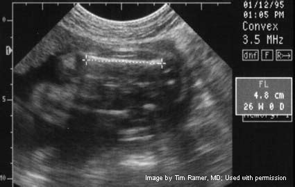 Femur Length Measurement Ultrasound