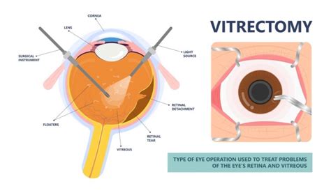 What Is Vitrectomy Retina Surgery Turkey Istanbul Medical