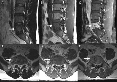 Bone Involvement In Secondary Syphilis A Case Report And Sy