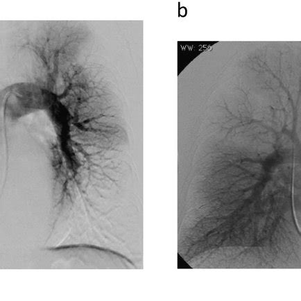 A Pre Operative Pulmonary Artery Angiography In Case 3 Showing