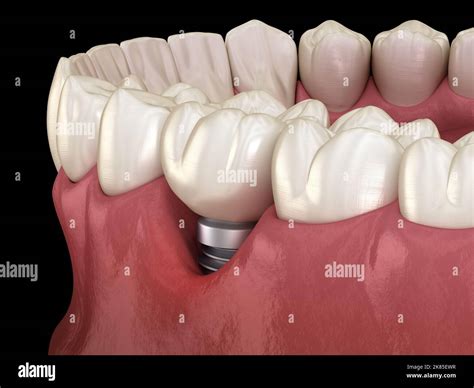 Peri Implantitis With Visible Gum Recession Medically Accurate 3d