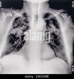 X Ray Medical Picture Chest And Lungs Stock Photo Alamy