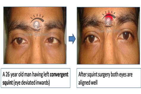 Convergent Squint - surgery - Utsav Eye Clinic